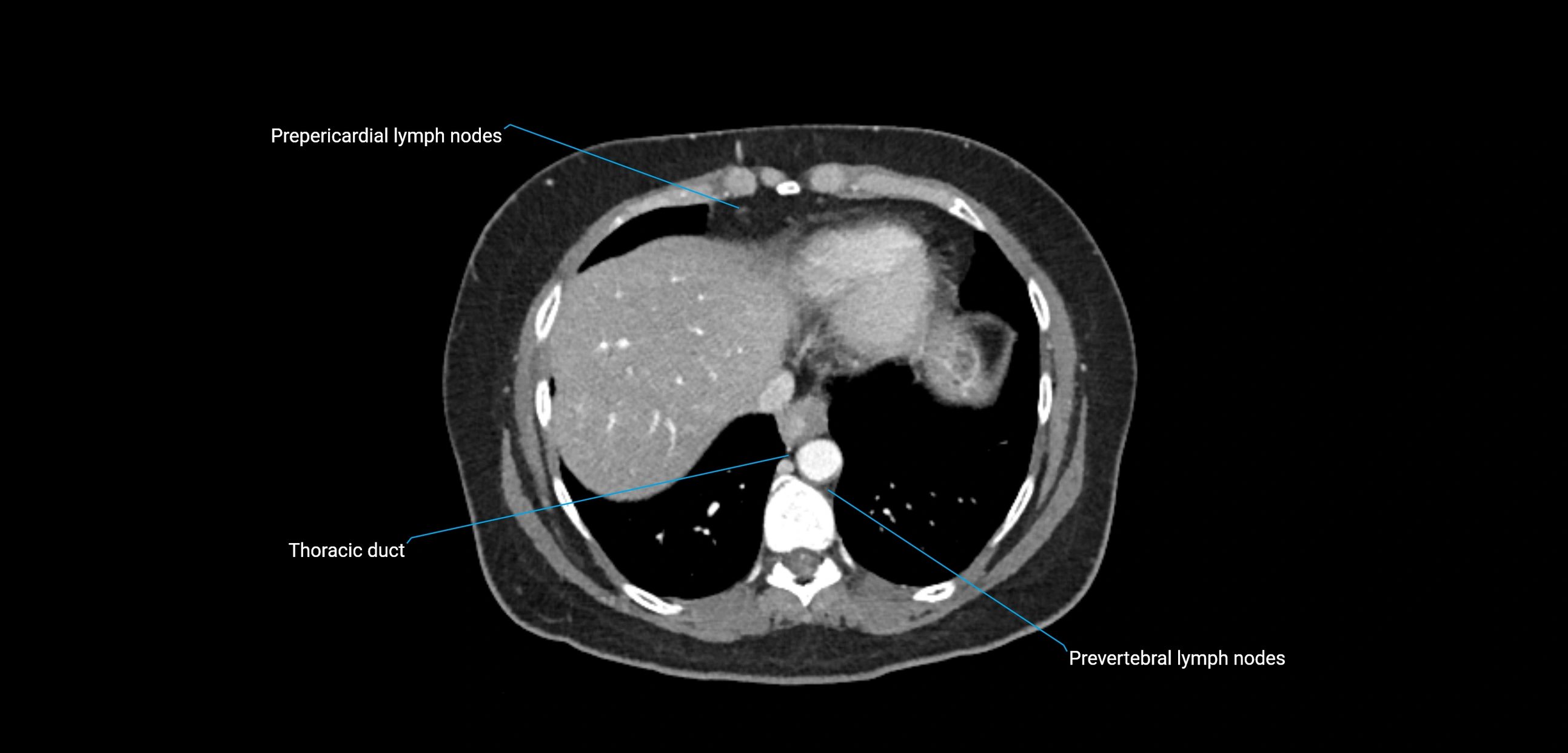 CT ct abdominal lymph nodes  axial cross sectional anatomy  enchanced radiology image -img-00002-00069.webp